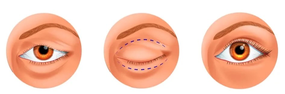 Блефаропластика